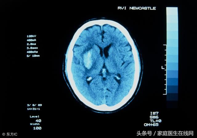 脑出血前兆的6个表现是什么_http://www.zhaochafa.com_信息发布_第1张