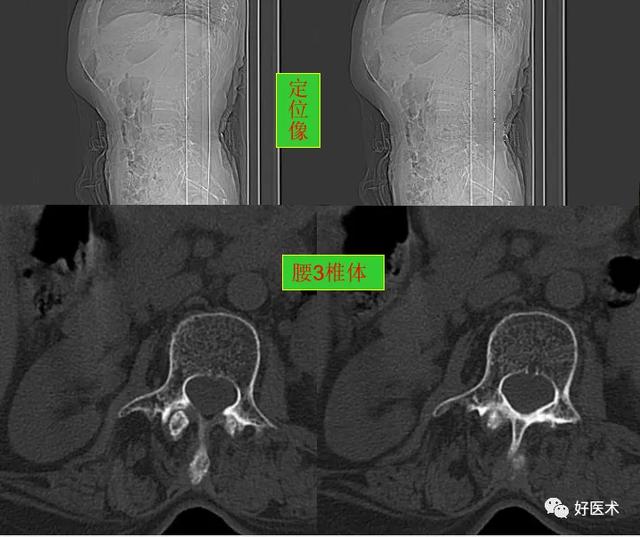 零基础30分钟学会看腰椎ct_http://www.zhaochafa.com_信息发布_第1张